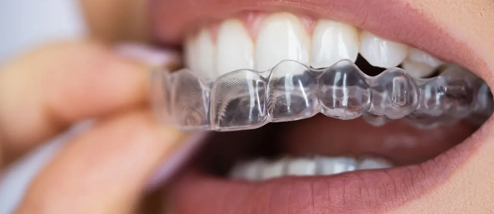 Aligners & Invisalign Frankfurt: Process & Expert Guide